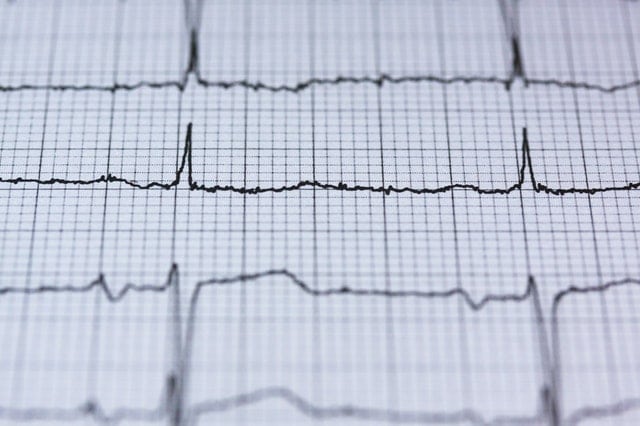 EKG tracing